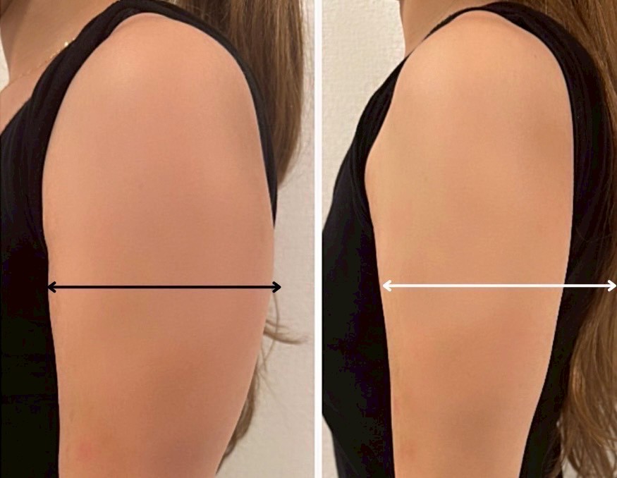 二の腕 ビフォーアフター