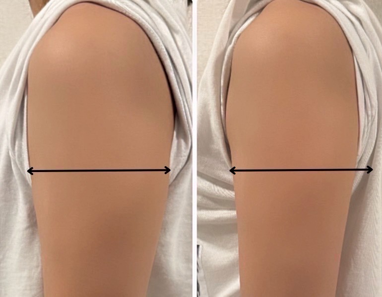 二の腕 ビフォーアフター2