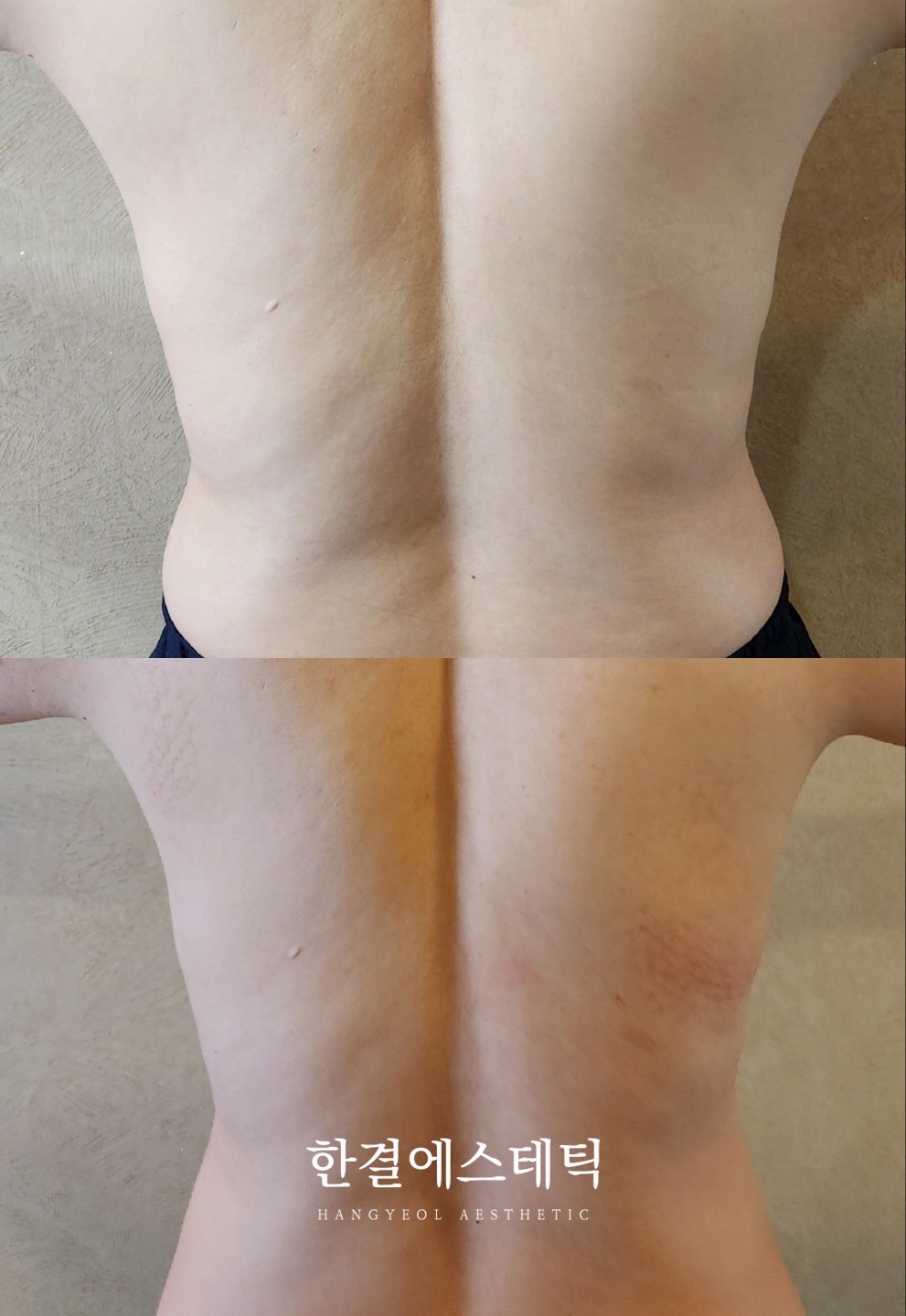 背中全体 ビフォーアフター