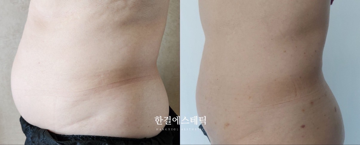 お腹側面 ビフォーアフター