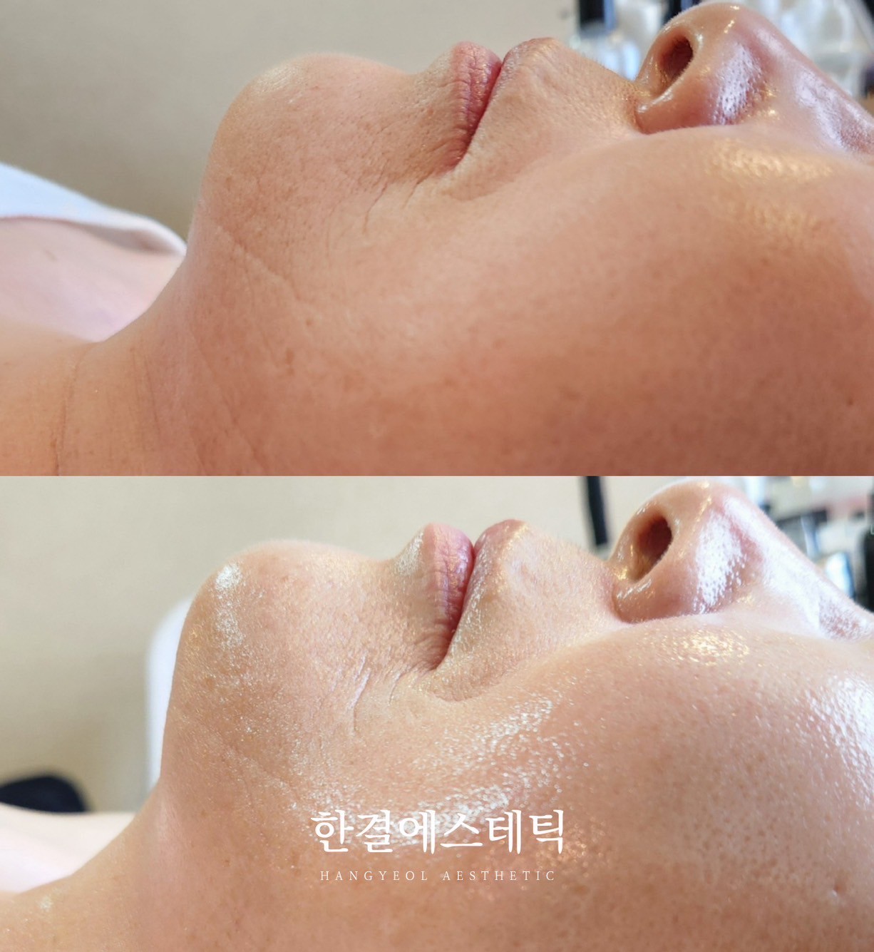 顎アングル ビフォーアフター