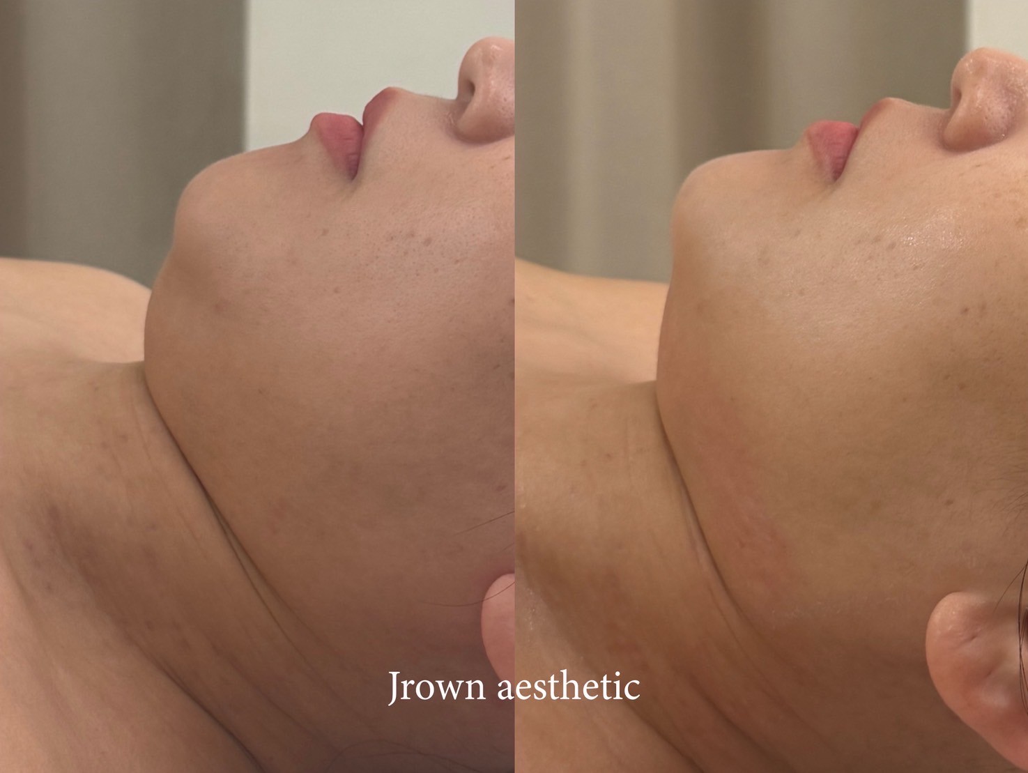 顎下 ビフォーアフター