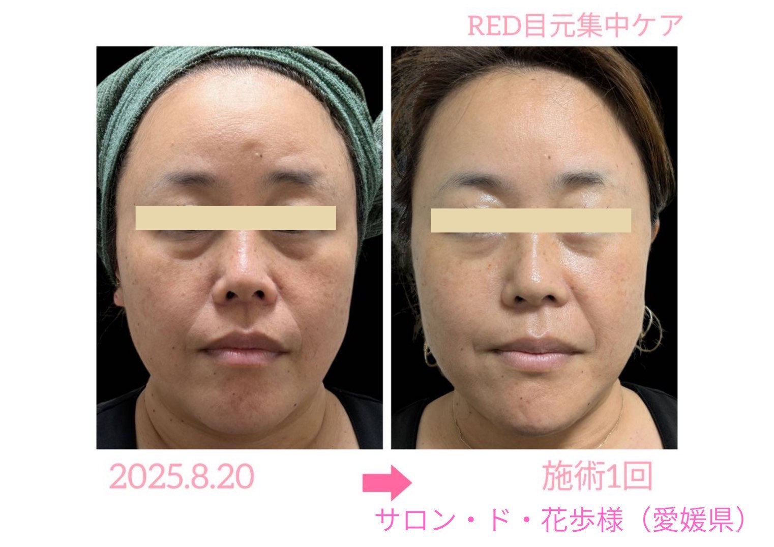 目元ケア ビフォーアフター