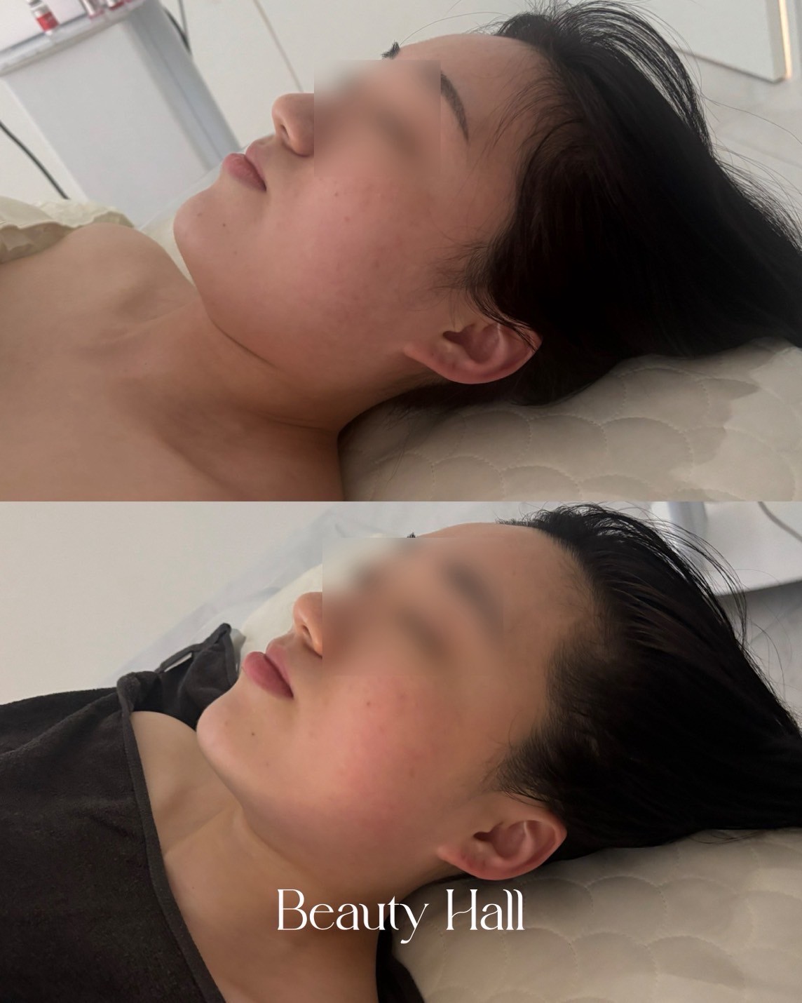 フェイスライン横顔 ビフォーアフター