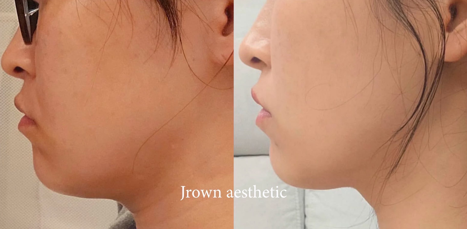 フェイスライン ビフォーアフター