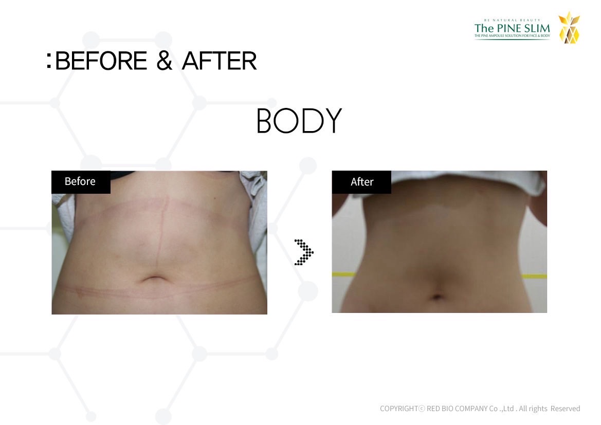 パインショット Before After ボディ3