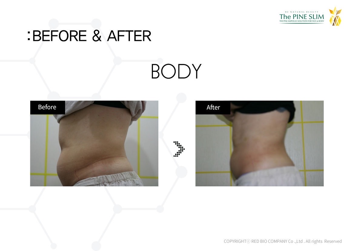 パインショット Before After ボディ5