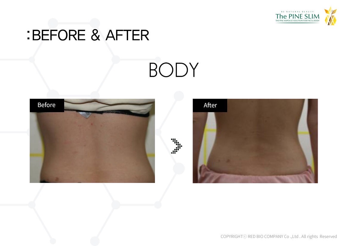 パインショット Before After ボディ6