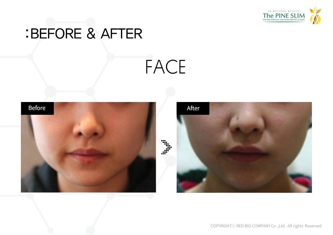 パインショット Before After フェイス1