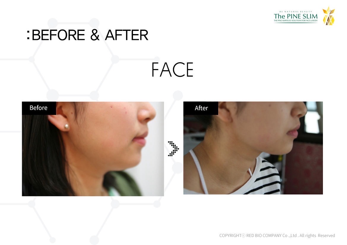 パインショット Before After フェイス4