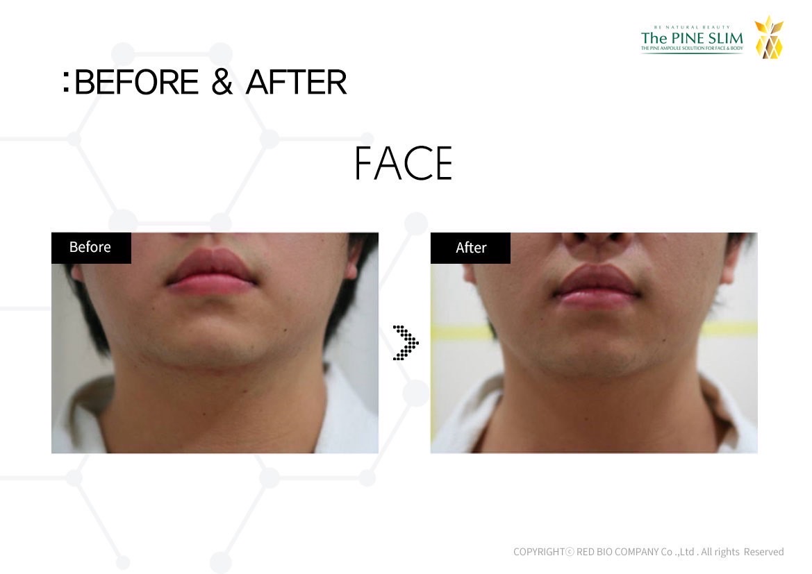 パインショット Before After フェイス5